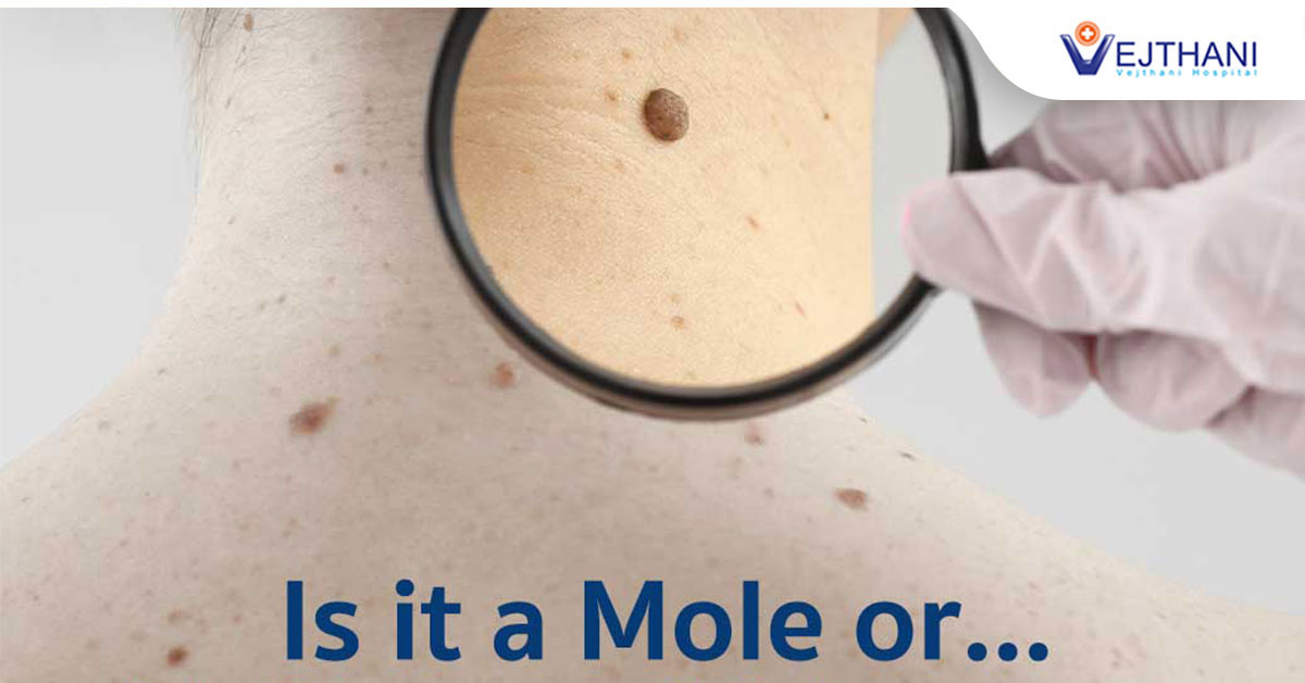 Malignant Melanoma Life Cancer Center