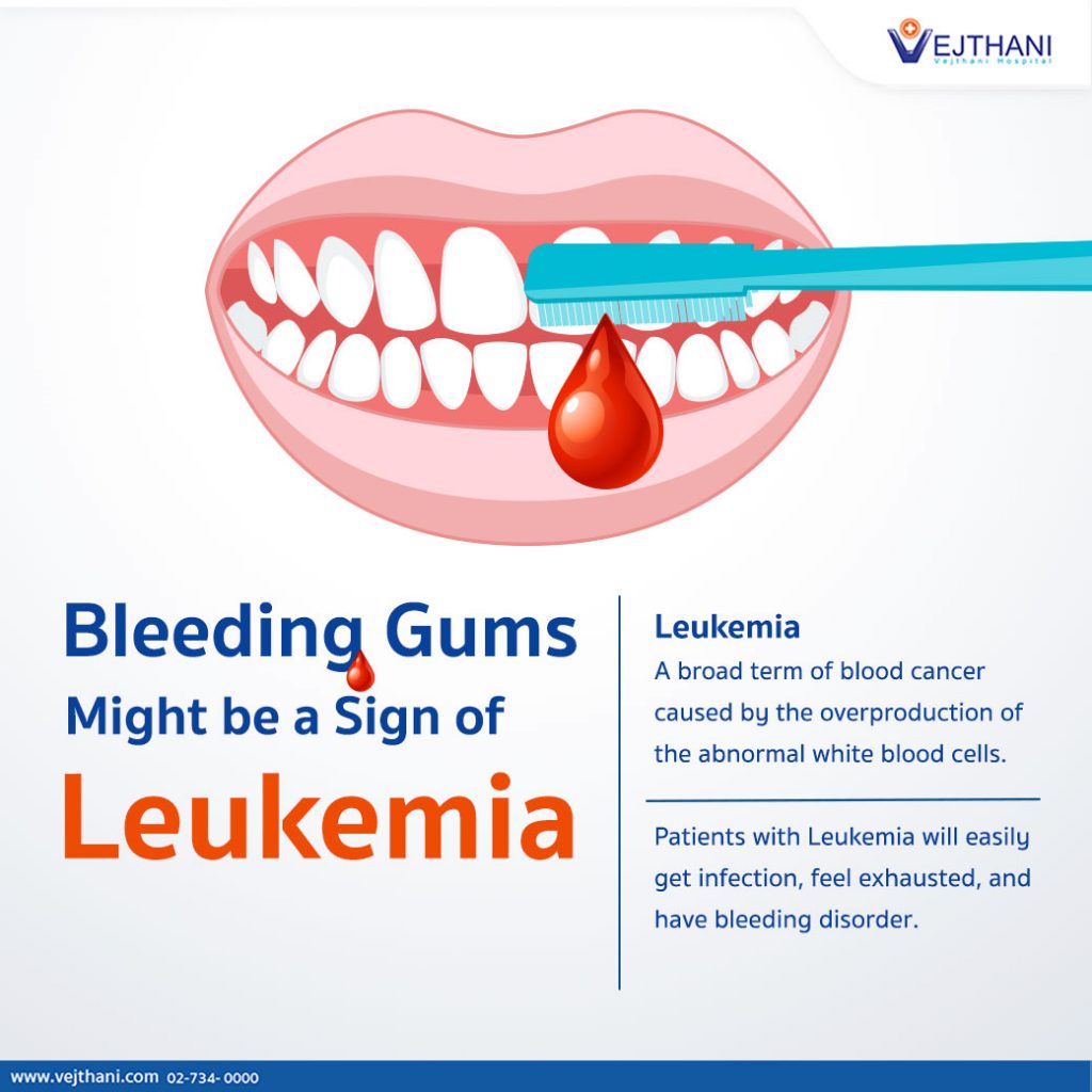 Bleeding Gums Might be a Sign of Leukemia