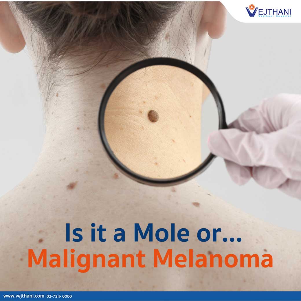 Malignant Melanoma