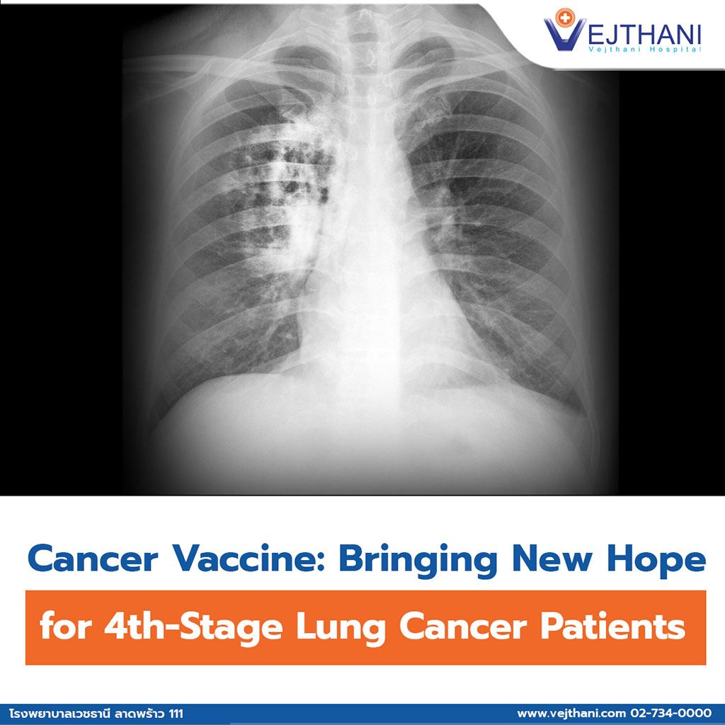 Cancer Vaccine: Bringing New Hope for 4th-Stage Lung Cancer Patients