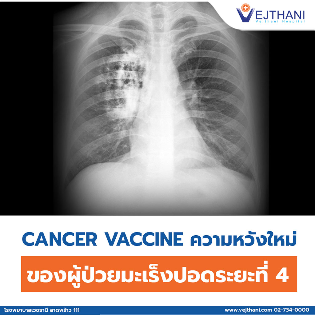 Cancer Vaccine ความหวังใหม่ของผู้ป่วยมะเร็งปอดระยะที่ 4