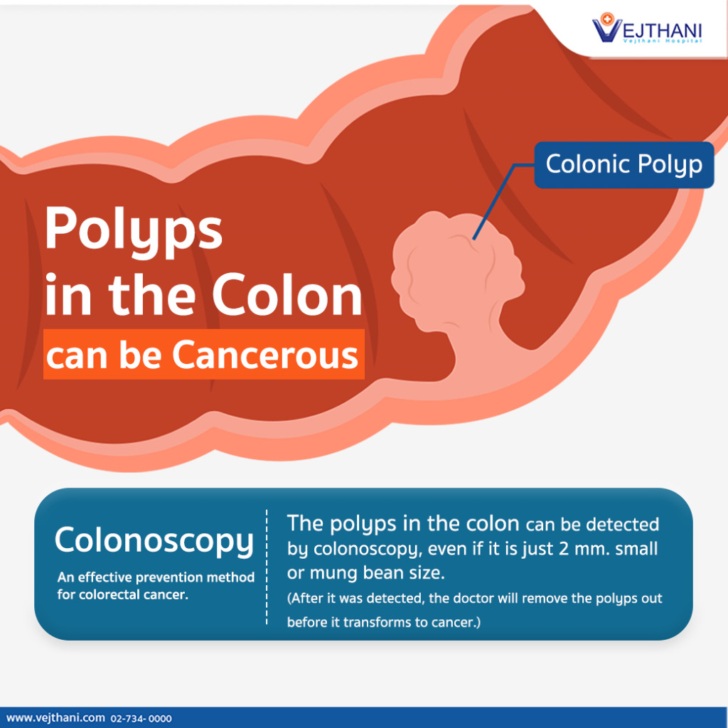 Polyps in the Colon can be Cancerous
