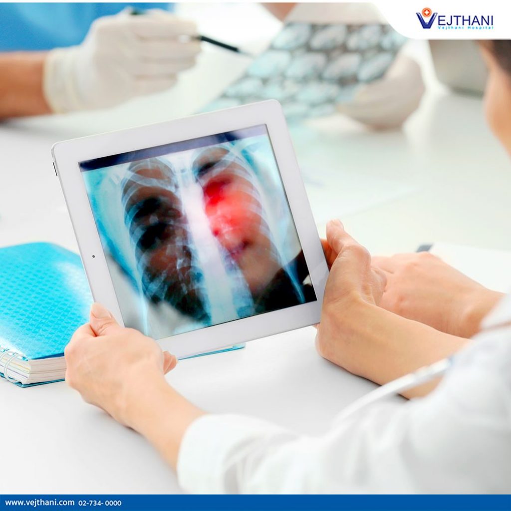 Stages of Lung Cancer