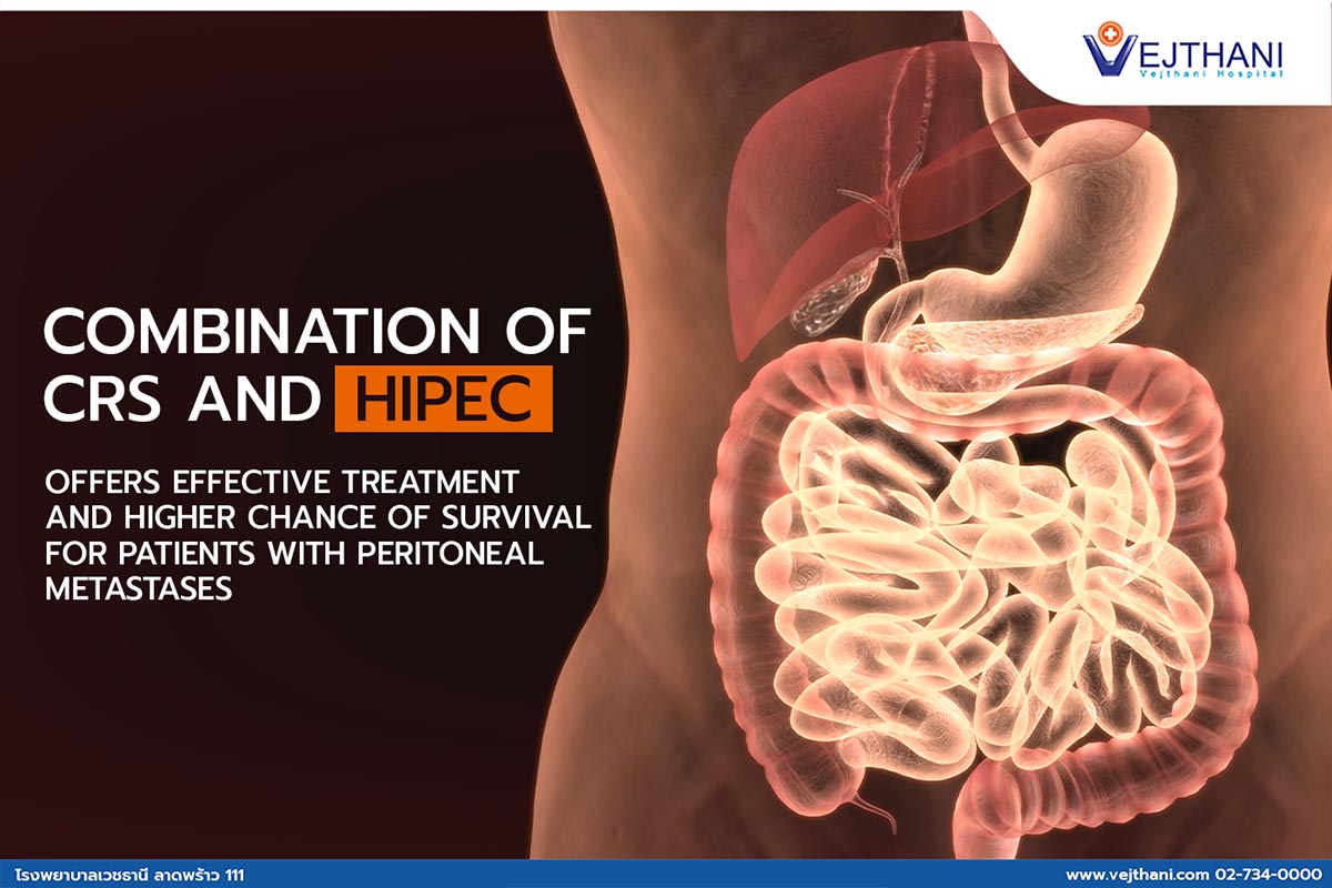 الدمج بين جراحة إستئصال الكتلة (CRS) والعلاج الكيميائي عالي الحرارة (HIPEC) في العلاج المرضى الذين يعانون من النقائل البريتونية