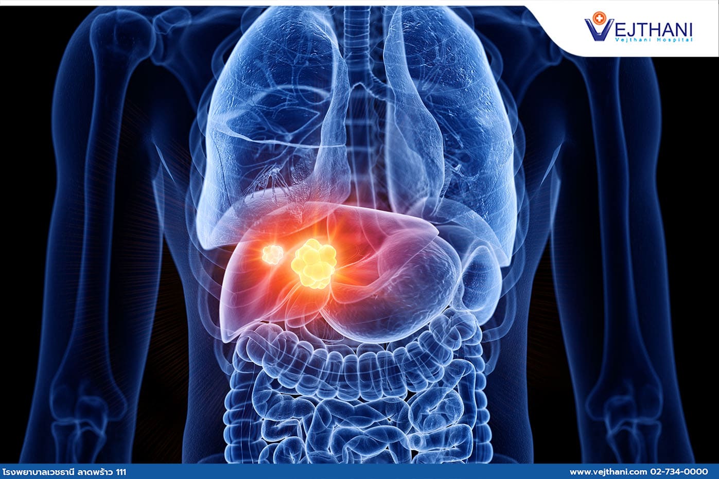 Transarterial Chemoembolization (TACE), Alternative Chemotherapeutic Agent Given Through Artry for Precise Liver Cancer Treatment