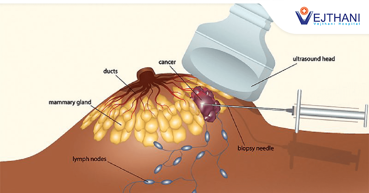 Breast Lump Biopsy Addressing Anxiety And Uncertainty With Prompt breast-lump-biopsy-addressing-anxiety-and-uncertainty-with-prompt
